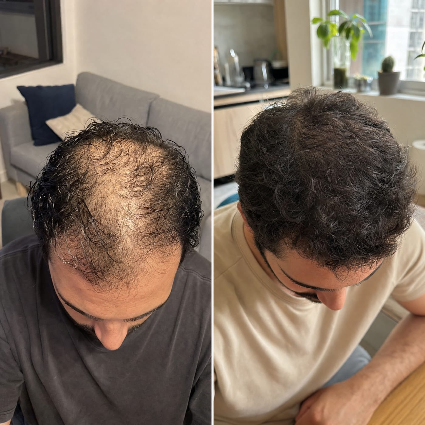 Native hair thinning around a transplant