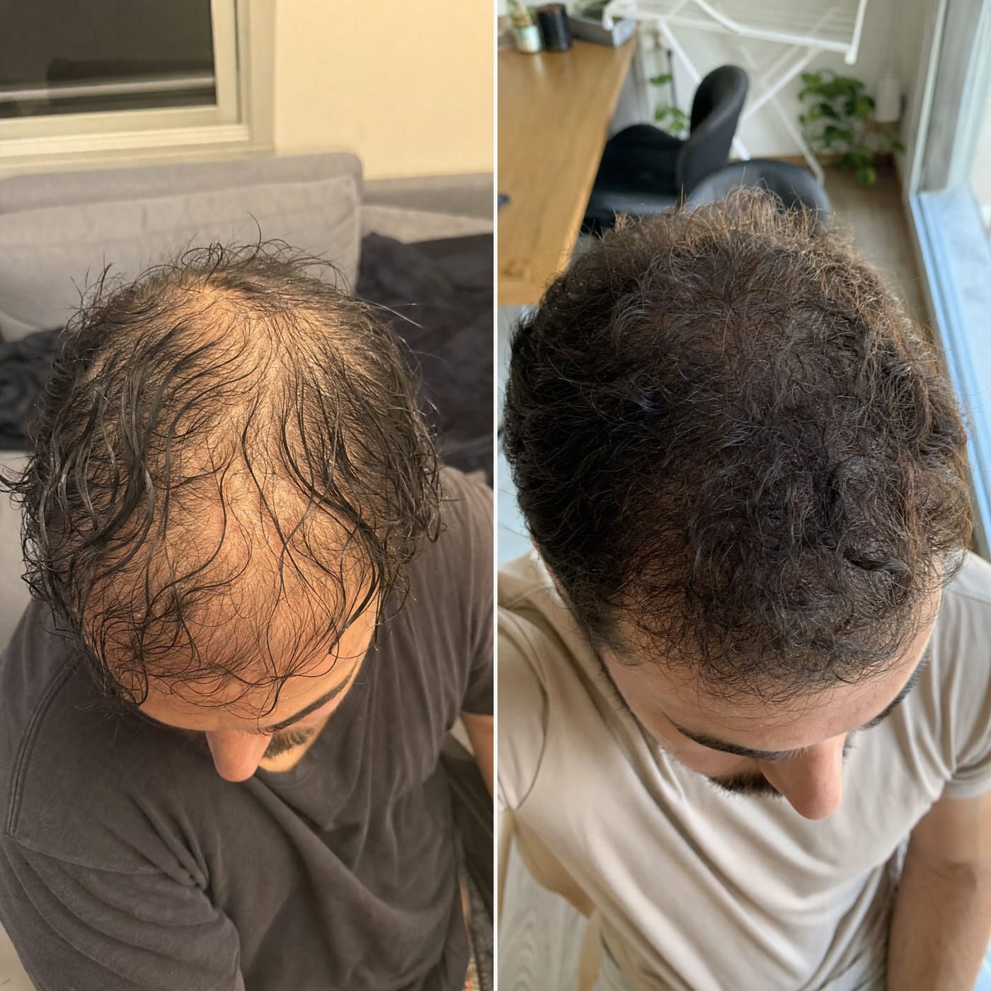 Receding temples and a thinning crown